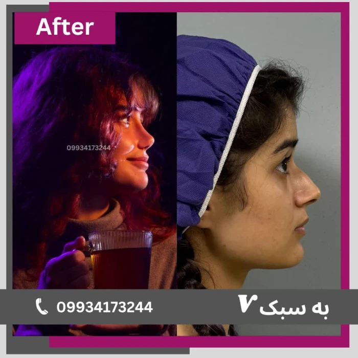 نمونه جراحی بینی ظریف و طبیعی دکتر آرزو خوانساری نیا جراح بینی تهران