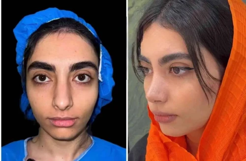 نمونه جراحی بینی طبیعی توسط دکتر خوانساری نیا