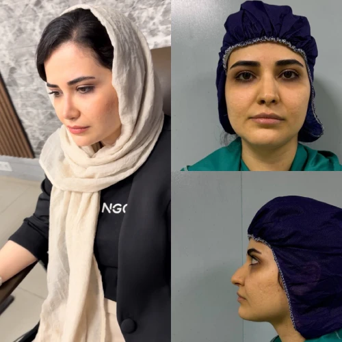 کلاژ قبل و بعد جراحی بینی دکتر آرزو خوانساری‌نیا در نماهای روبه‌رو، سه‌رخ و نیم‌رخ