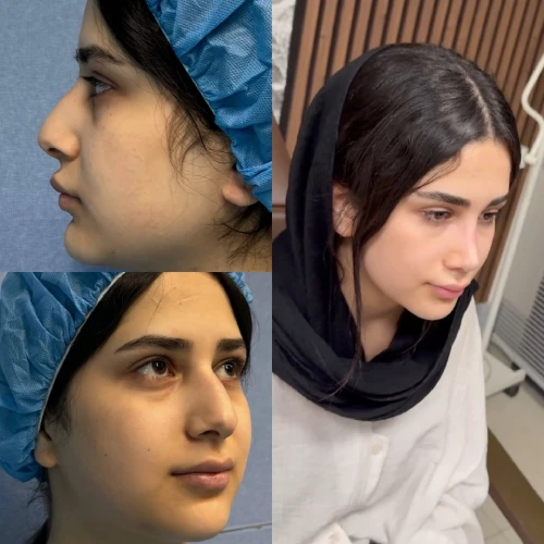 نمونه نتیجه جراحی بینی دکتر آرزو خوانساری‌نیا