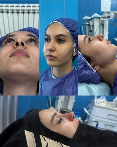 تصویر قبل و بعد عمل بینی ترمیمی و زیبایی صورت