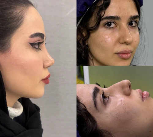نمونه جراحی بینی دکتر اکبر اعتمادی