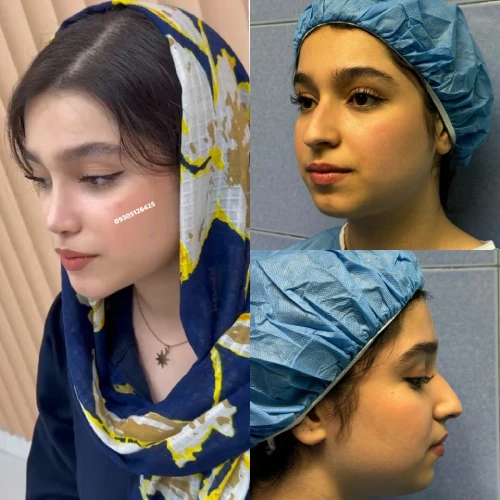 طراحی نوک بینی فانتزی توسط دکتر علی شکرریز
