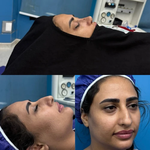 نمونه نتیجه جراحی زیبایی بینی دکتر علی شکرریز