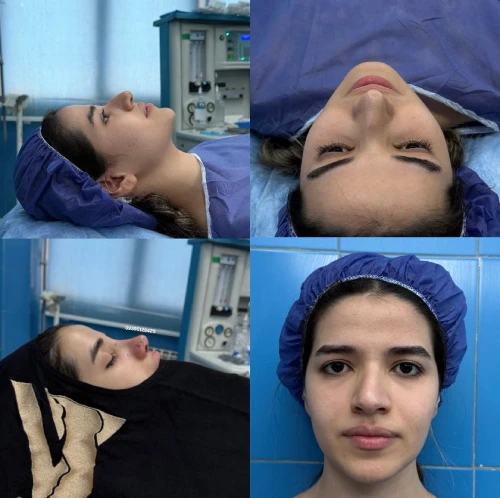 نتیجه نهایی جراحی بینی فانتزی دکتر علی شکرریز