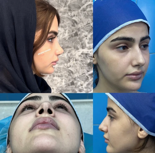 نمونه جراحی بینی دکتر علی شکرریز