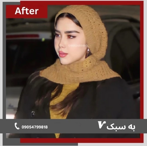 تصویر نمونه قبل و بعد جراحی بینی دکتر خسرو مقتدر