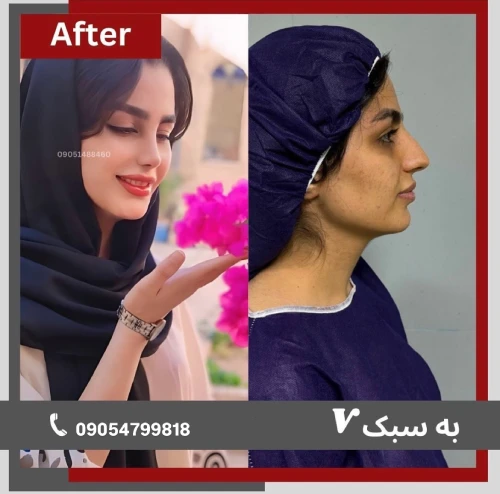 نمونه نتیجه رینوپلاستی انجام‌شده توسط دکتر خسرو مقتدر