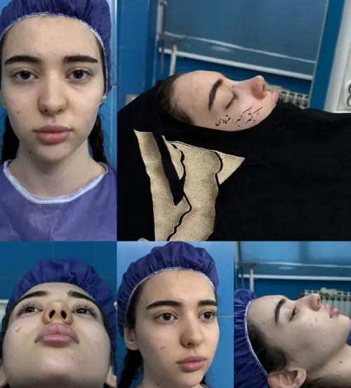 نمونه فرم بینی با طراحی ظریف توسط دکتر امین بختیاری
