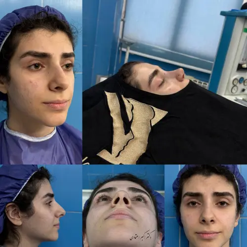 نتیجه جراحی زیبایی بینی و تناسب فرم صورت دکتر امین بختیاری