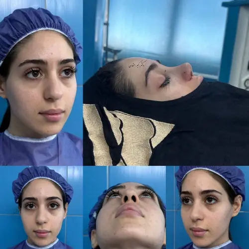 نمونه جراحی بینی نیمه فانتزی دکتر امین بختیاری