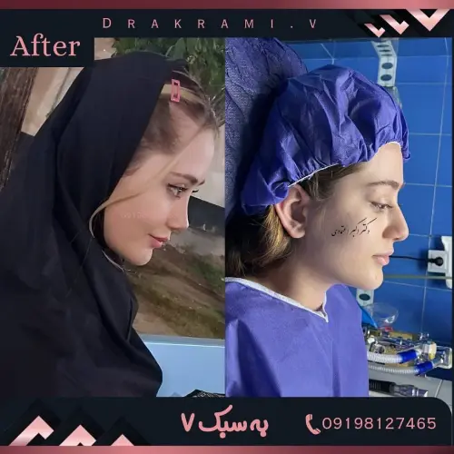 تصاویر قبل و بعد جراحی بینی دکتر امین بختیاری در نماهای مختلف چهره