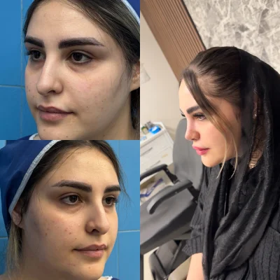 نتیجه جراحی بینی با فرم ظریف و متناسب