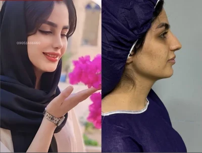 نمونه کار جراحی بینی دکتر خسرو مقتدر