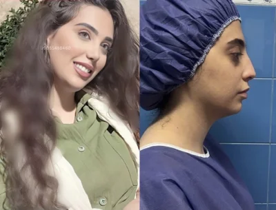 نمونه جراحی بینی دکتر خسرو مقتدر