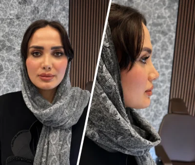 تصاویر قبل و بعد جراحی بینی دکتر علی شکرریز