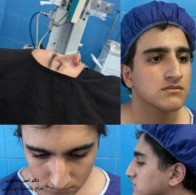 نمونه نتیجه جراحی بینی دکتر علی شکرریز